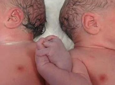 Фото заслуживает миллион слов . 14 мая в Барселоне,родились близнецы.Вся больница сбежалась ,увидеть незабываемую картину.Руки близнецов переплетались.Это прекрасный жест, чтобы запомнить навсегда!!!